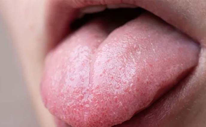 চিকিৎসকের কাছে গেলে আগে জিভ দেখাতে বলে কেন?