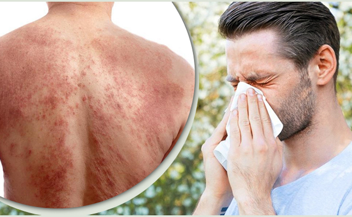 শীতে কোন কোন অ্যালার্জি বেড়ে যায়?